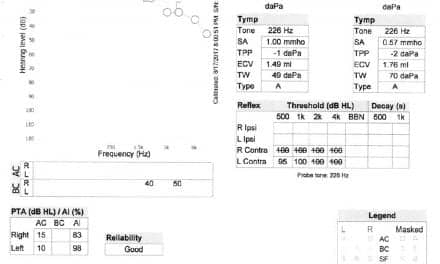 Acoustic Neuromas and Sudden Sensorineural Hearing Loss: A Case Study