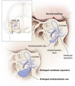 This diagram shows the anatomy of the inner ear. Hearing loss and deafness may occur when the inner ear is enlarged due to failure of fluid absorption in the endolymphatic sac. This failure of fluid absorption has now been established as a root cause of hearing loss.