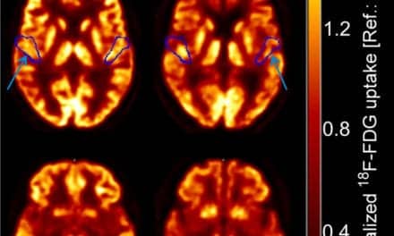 High-Resolution PET/CT Imaging Assesses Brain Stem Function in Patients with Hearing Impairment