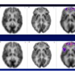 Hearing Aids Slow Brain Metabolic Decline in Adults with Mild Cognitive Impairment