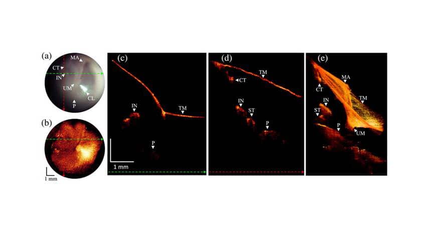 New Imaging Device Improves Ear Disease Diagnosis