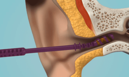 Earways Medical Patent for Cerumen Removal Innovation Approved