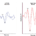 Part 2: Audiovestibular Symptoms Related to Migraine – What Audiologists and ENTs Need to Know in 2022 for Expanding Patient Care